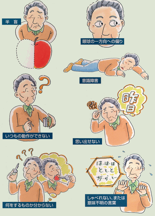 はっきりした症状が出ない「脳梗塞」。発症サインを見逃さないためには!? 『名医が答える！ 脳梗塞 治療大全』ダ・ヴィンチWeb