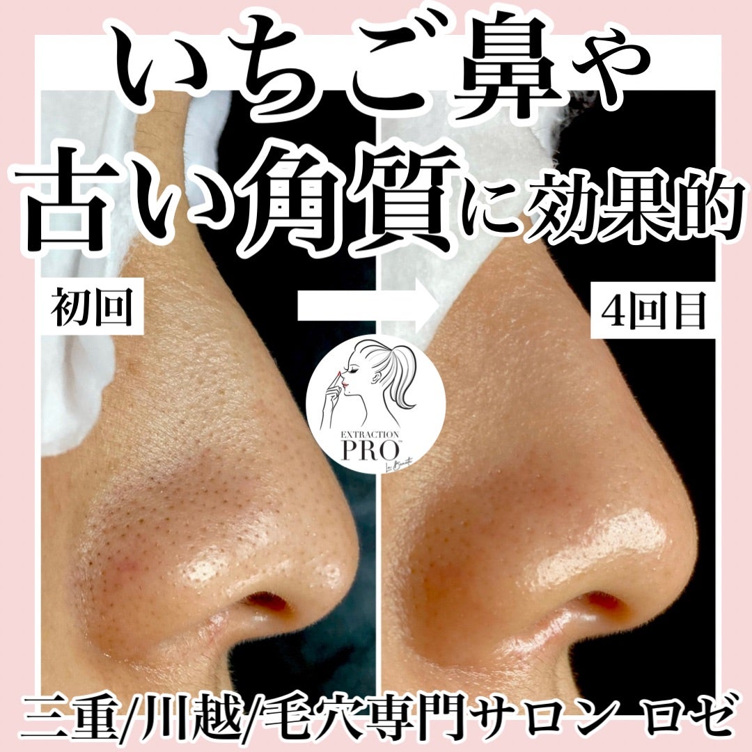 黒ずみ毛穴 いちご鼻ケア方法＆角栓の取り方最新おすすめアイテムも美的.com