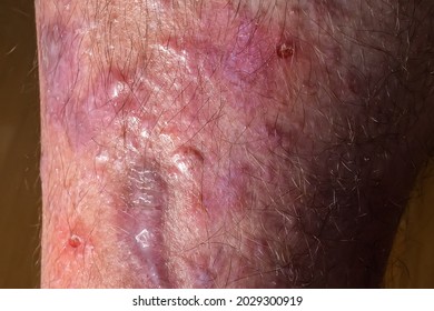 扁平苔癬とは小嶋デンタルクリニック