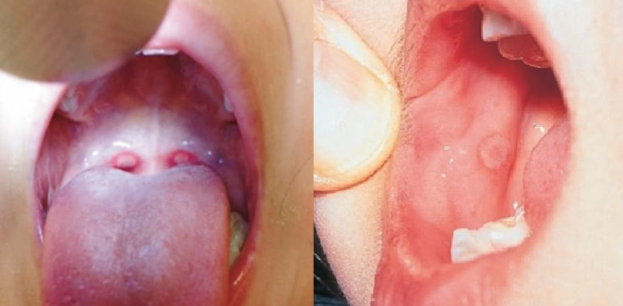 手足口病が全国的に流行 今年はワンシーズンに2度感染？ 予防法はなんといっても○○！学習と健康・成長朝日新聞EduA