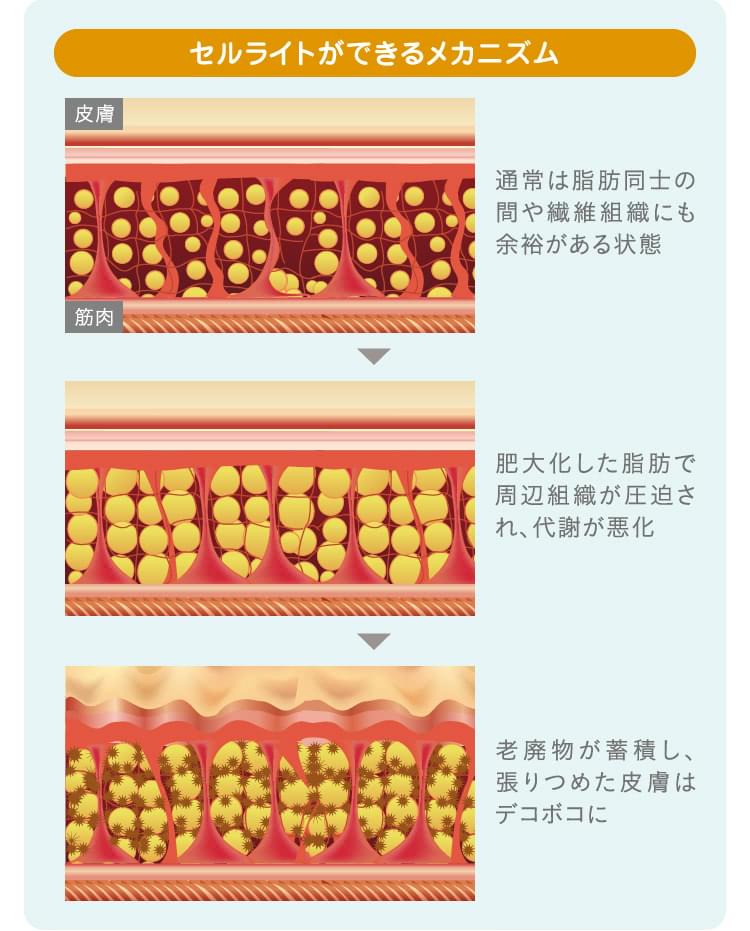 二の腕のセルライト解消法を解説！安全・確実に除去できる方法も紹介セルライトのススメ