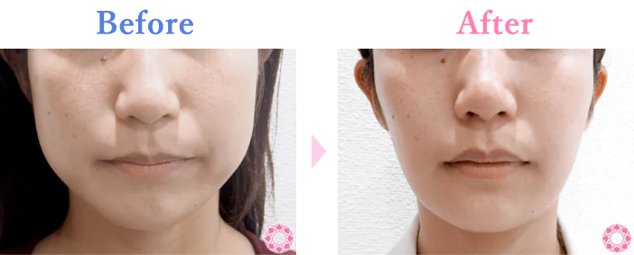 エラボトックス注射 アラガン で小顔効果シャープなフェイスライン 若返り・エイジングケアなら湘南美容クリニック 公式