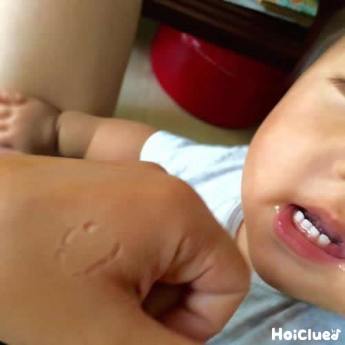 症例41：指の犬咬傷つかもと内科