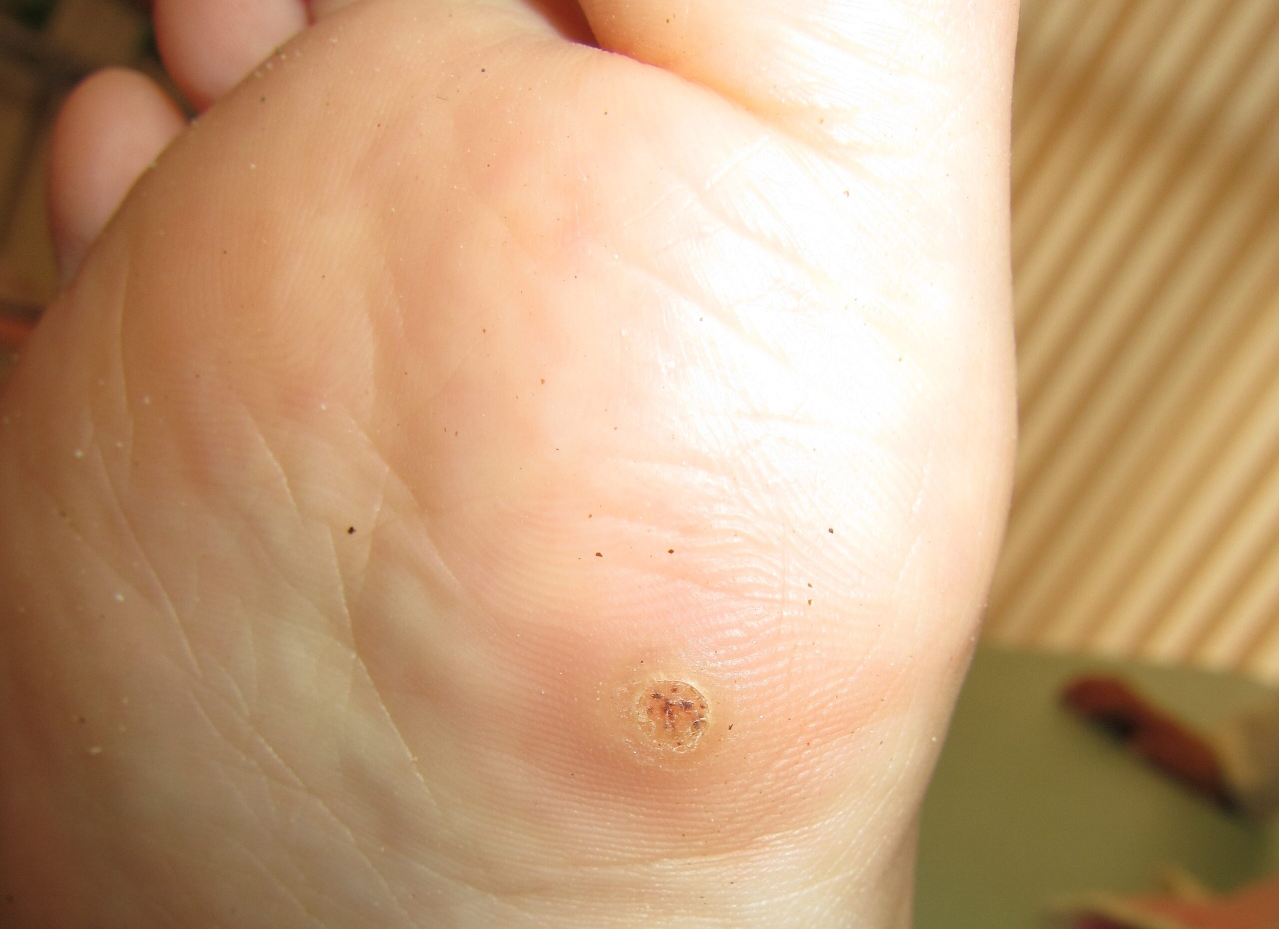 イボの原因とは？種類や治療方法も解説 - 板橋区成増駅前かわい皮膚科