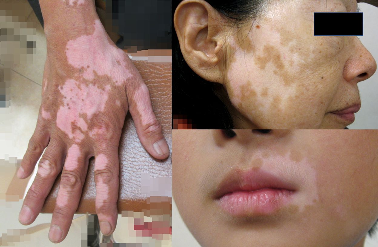 はたけ 皮膚 でしょうか？55歳男性の、腕や脇腹、肩に出来ています。少し痒いそ- Yahoo!知恵袋