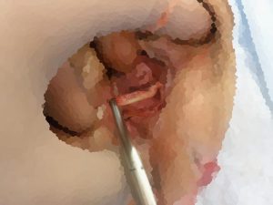 骨盤臓器脱 子宮脱 手術』Net腹腔鏡下仙骨膣固定術 LSC ノート 10