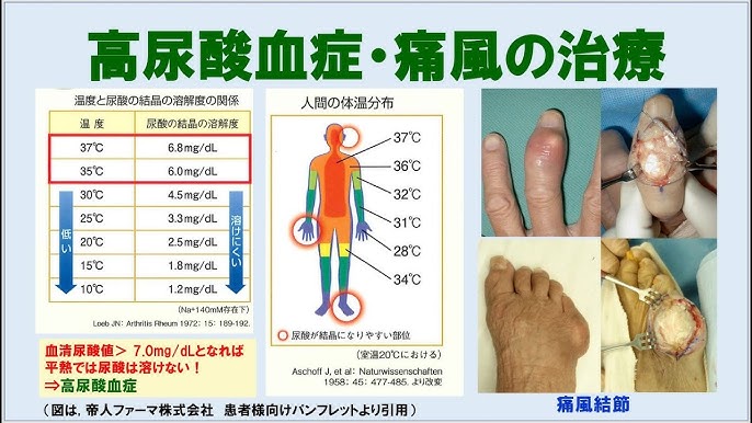 なぜ？かかとの後ろが痛い 原因は？病院は何科？痛風サインの可能性もMedicalook メディカルック