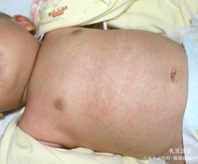 赤ちゃんアトピー性皮膚炎ステロイド未使用の内服薬アトピー体質改善脱ステロイド日本神奈川県相模原市