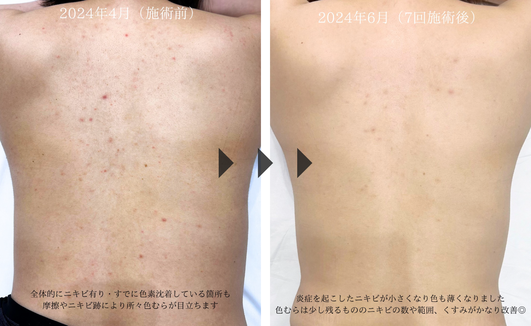 毛穴 開き・黒ずみ 治療なら美容皮膚科シロノクリニック恵比寿院 東京都渋谷区