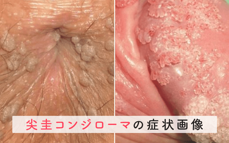 執筆論文解説28 尖圭コンジローマが充満した痔瘻内科、外科、整形外科、大腸肛門科なら大阪寝屋川の道仁病院