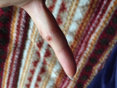 イボつさかこどもおとな皮膚科・泌尿器科練馬区-練馬駅,桜台駅,江古田駅,小竹向原駅,氷川台駅「皮膚科専門医・泌尿器科専門医」