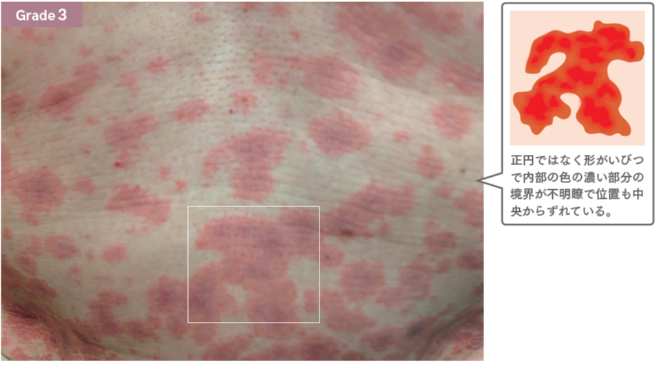 太もも・ひざ・ふくらはぎの丘疹皮膚トラブルの状態チェックヒフシルワカル