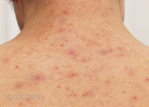 顔・首のにきび２か月半過ぎ ニキビ痕の瘢痕はどのくらいキレイになるの？エンビロン・肌質改善・大人にきび・エイジング 愛知県