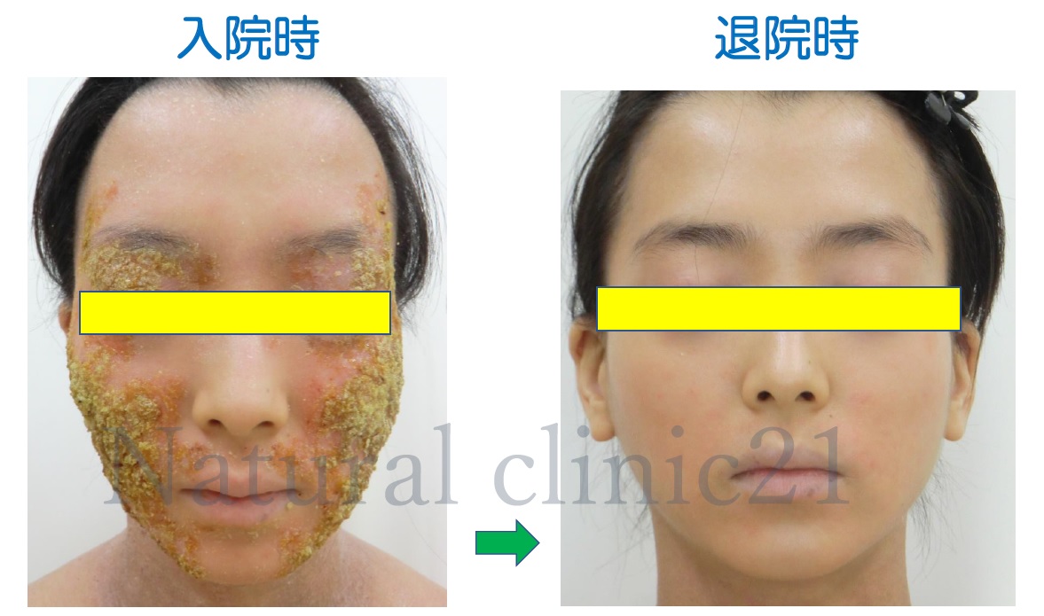 広島で顏のアトピー性皮膚炎・湿疹の事なら漢方薬局ハーブス