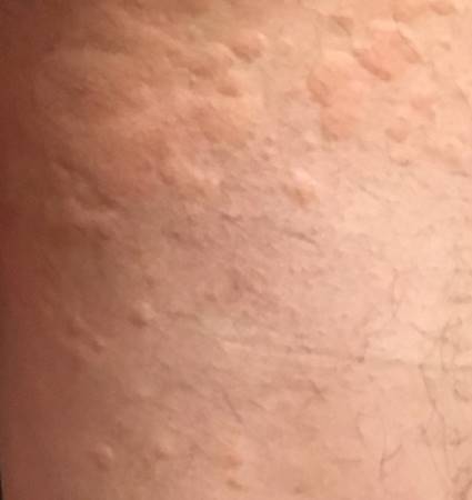 蕁麻疹 じんましん