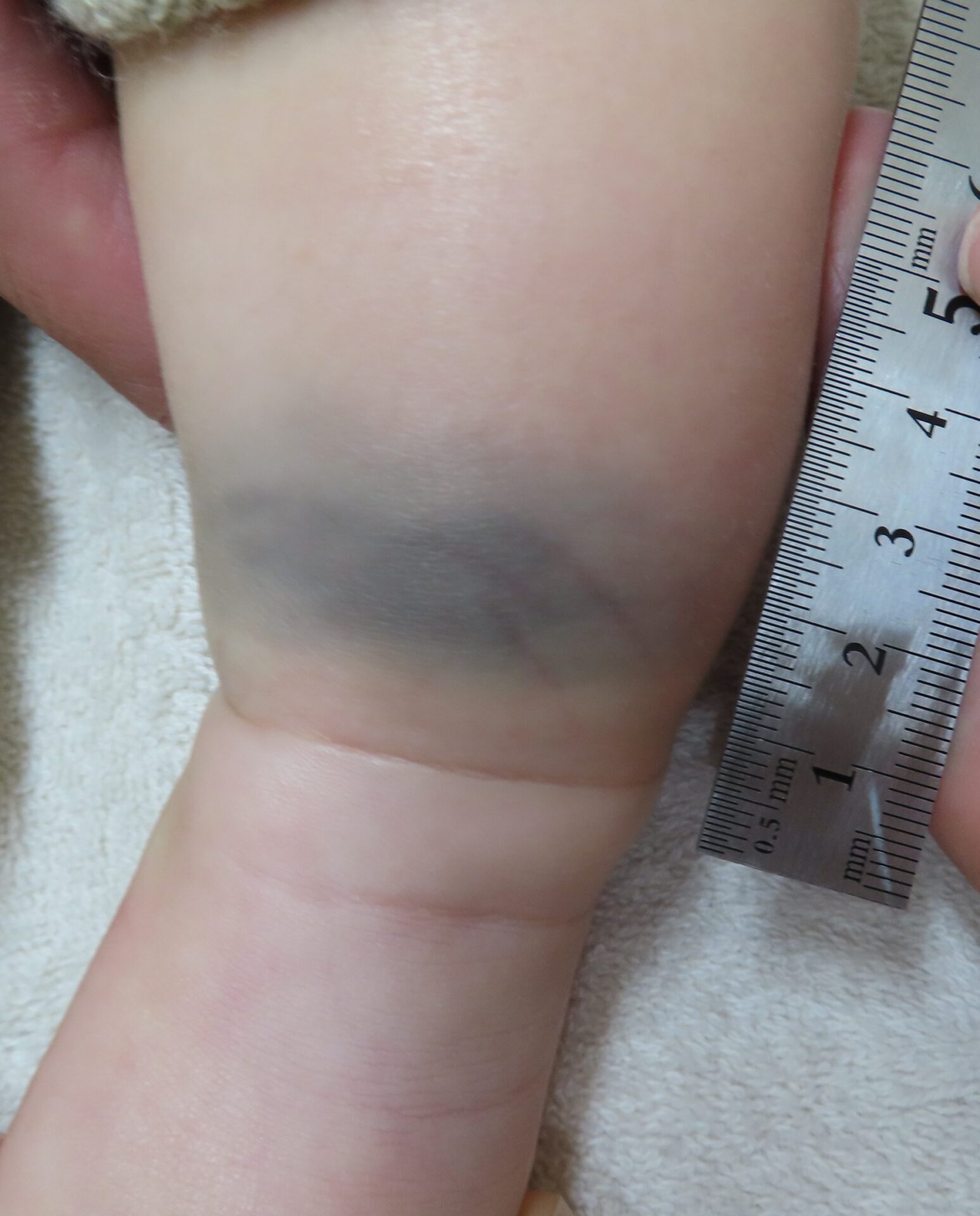 異所性蒙古斑あざ治療の専門クリニック西堀形成外科