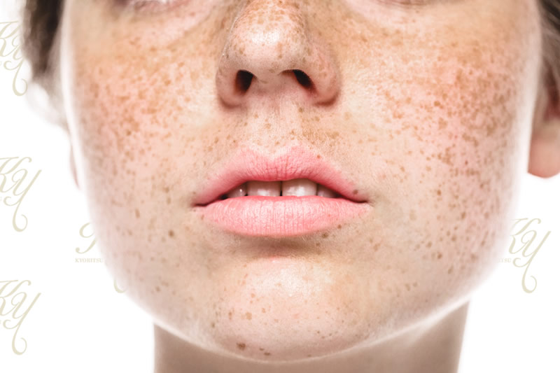 シミの種類の見分け方と対策 - 美容外科船橋中央クリニック&青山セレスクリニック