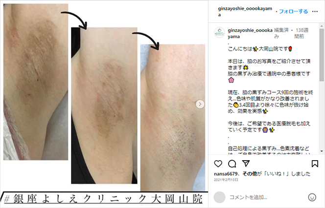 薬用ワキレーゼ スムースピーリングクリーム 20g 脇の黒ずみ 脇 黒ずみ 解消 デリケートゾーン わき 臭い 対策 角質 ピーリング 色素沈着 送料無料