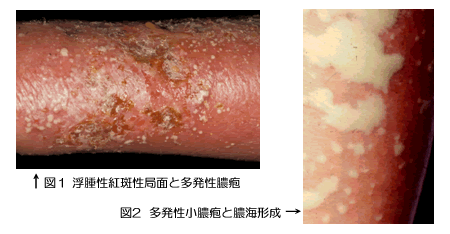 乾癬治療記乾癬の治療方法乾癬.comマルホ株式会社