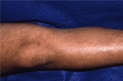 炎症後色素沈着の治療を皮膚科専門医が症例写真で解説うらた皮膚科