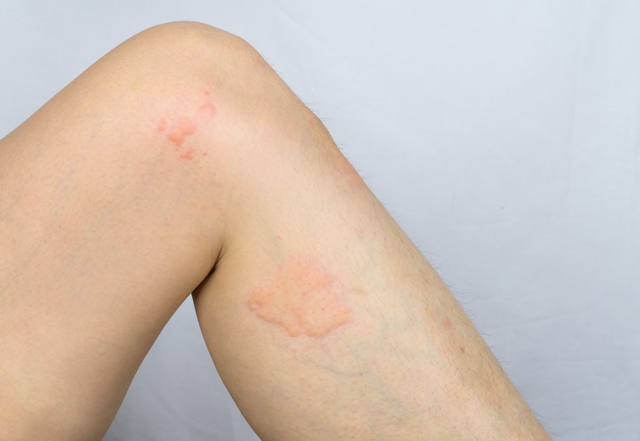 じんましん 恵比寿皮膚科クリニック恵比寿駅徒歩1分の皮膚科