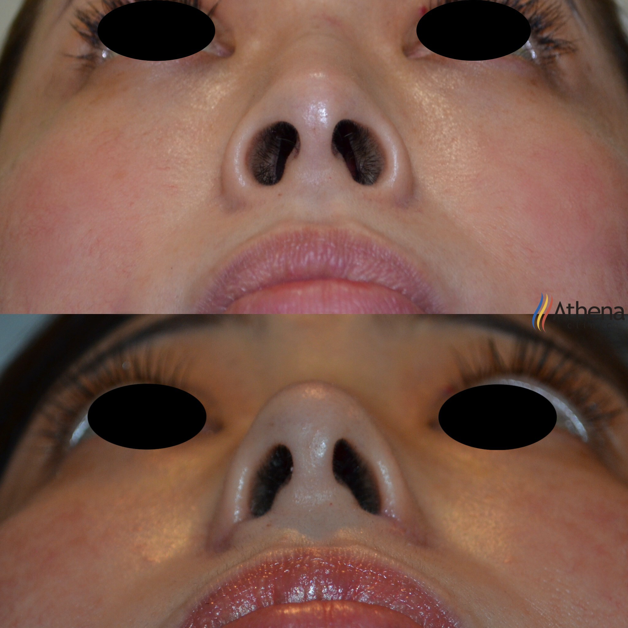 投稿例 鼻の穴を小さくするには？整形の種類や違いを紹介ドクターブログ鼻の整形なら東京イセアクリニック