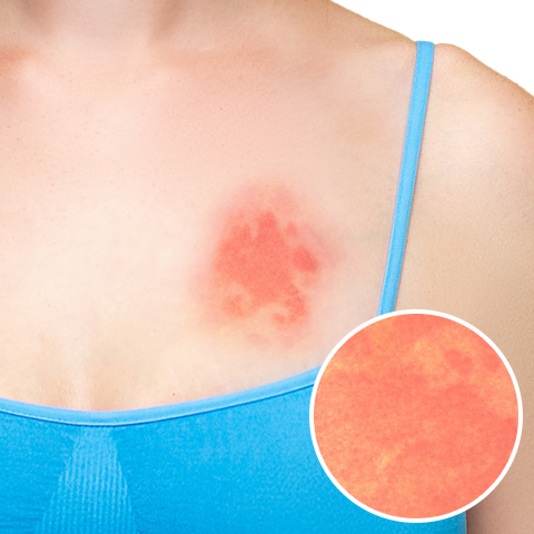 蕁麻疹 じんましん下永谷内科・皮フ科