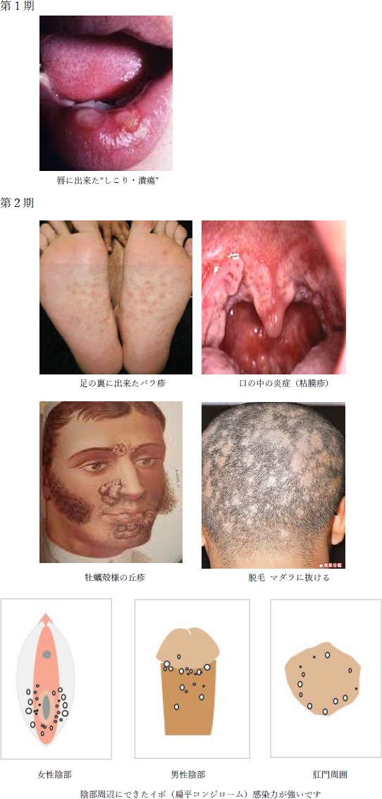 増え続ける梅毒患者 しこりや発疹受診早くヨミドクター 読売新聞