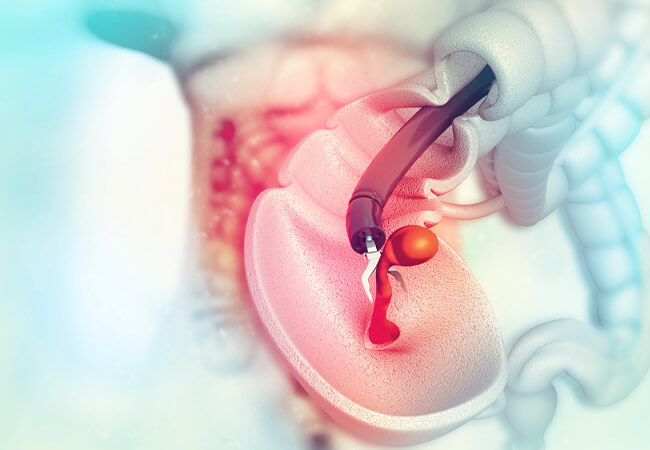 ヘリコバクター・ピロリの感染診断の決め手は 「温かいバリウム？」～胃Ｘ線検査の見地より – Radiology@Home