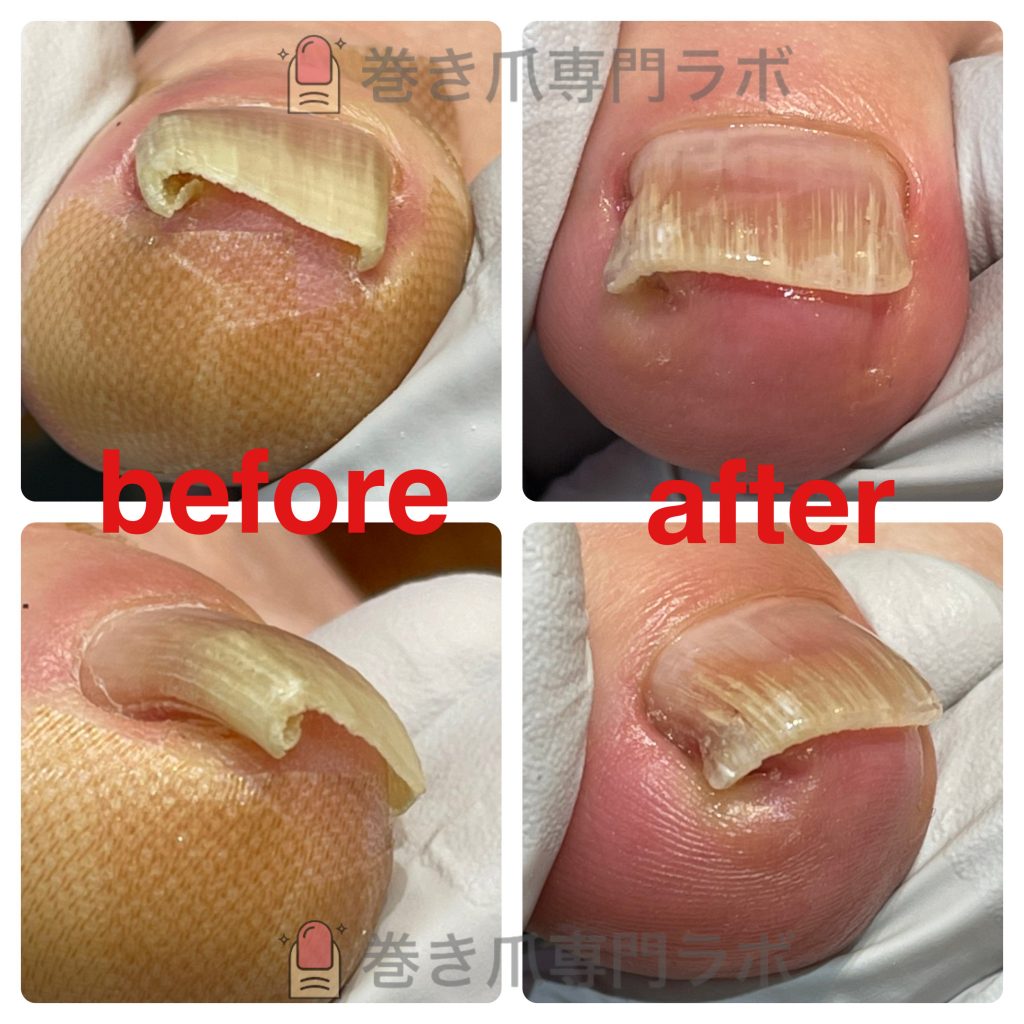 巻き爪の原因と予防貝印のツメキリポータルサイト