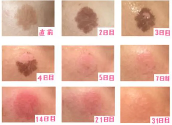 ピコレーザー美容皮膚科はTCBスキンクリニック