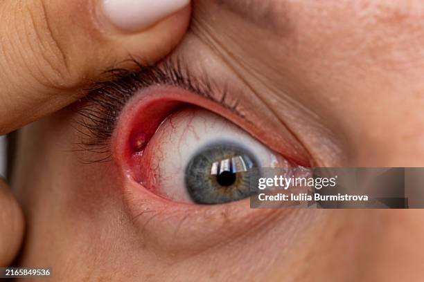 たかがものもらいと侮るなかれ