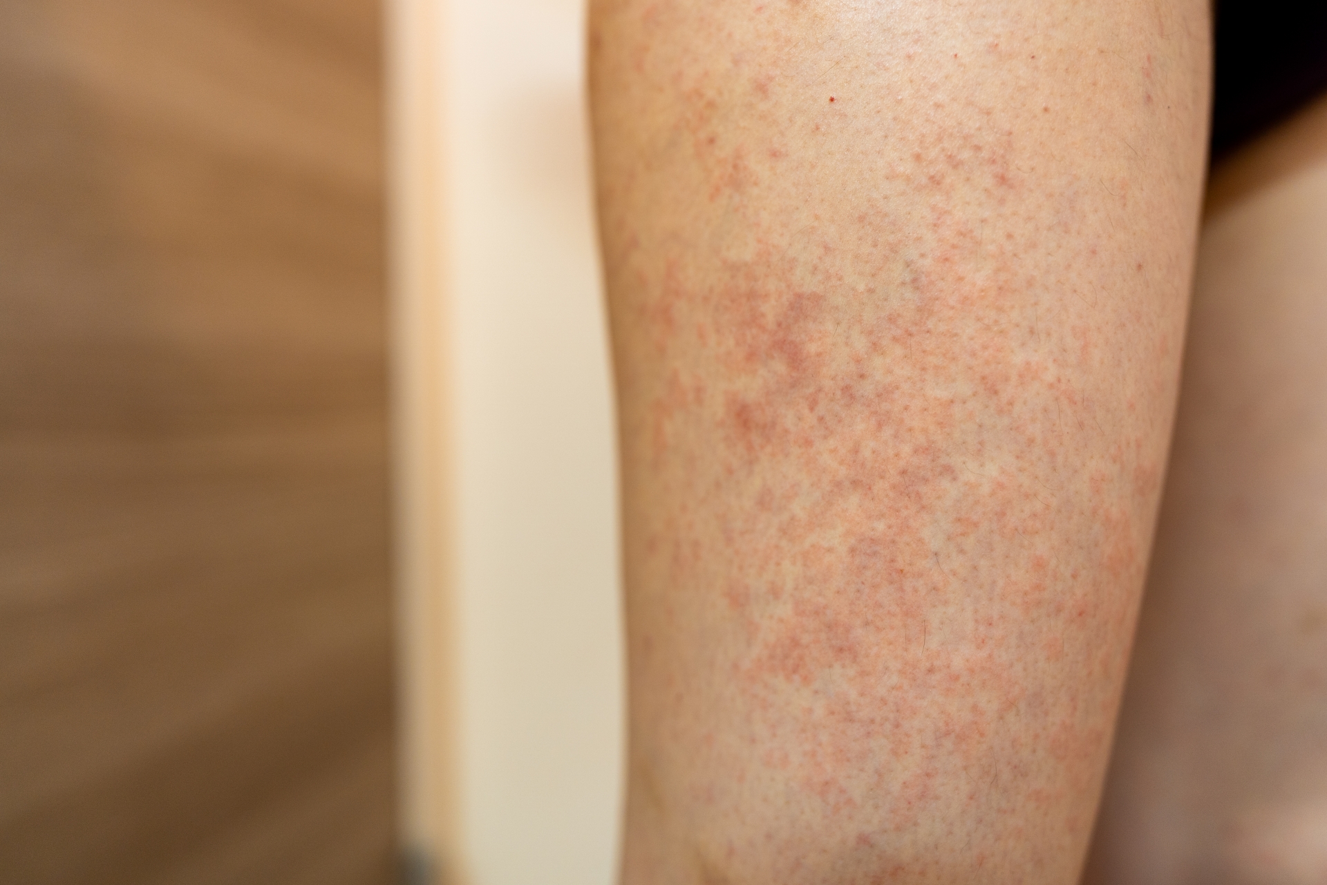 大阪の男性でアトピー性皮膚炎の治療を受けるならWクリニック