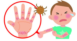 ウナｺｰﾜ 公式サイト ウナニュースかゆいブツブツ！これってダニ？あせも