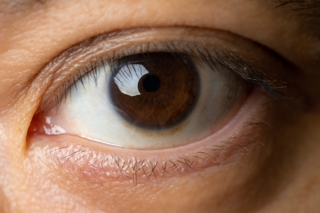 目をぶつけて、まぶたが腫れて内出血している赤ちゃん 2歳3か月、女の子、日本人Stock PhotoAdobe Stock