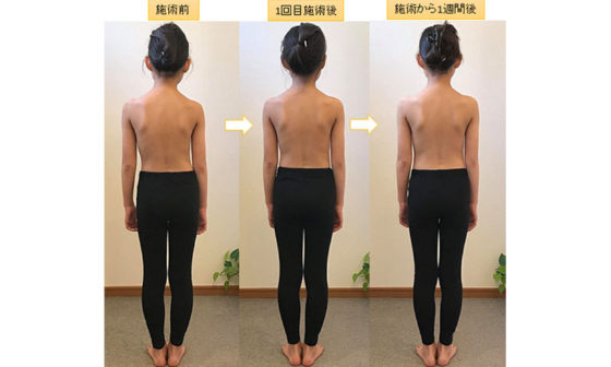 症状と受診のタイミング 側彎症のサイン 湘南藤沢徳洲会病院