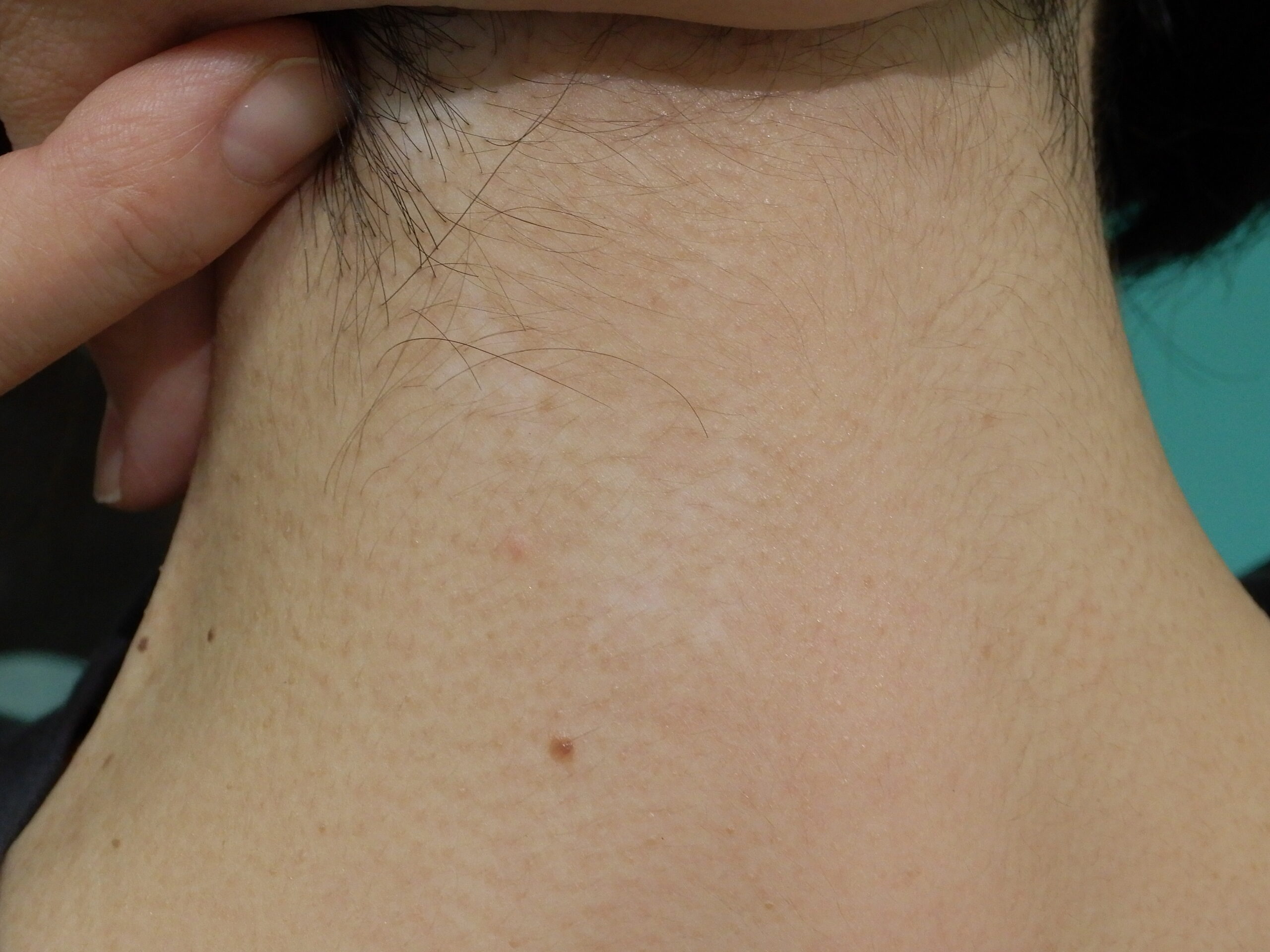 白斑でお悩みなら星の原クリニックへ 、紫外線・エキシマライト・マイクロ移植、フラクショナルレーザー等を行っています