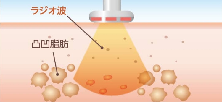 セルラジの主な効果🍀 1. セルライトの分解促進 ☆深部まで温めて脂肪を柔らかくし、分解をサポート！ 2. 代謝アップ‪☆血行・リンパの流れを改善し、老廃物を排出しやすく！ 3. 引き締め効果 ‪☆コラーゲン生成を促して、ハリや弾力アップにも。 4.冷え・むくみ改善‬‬