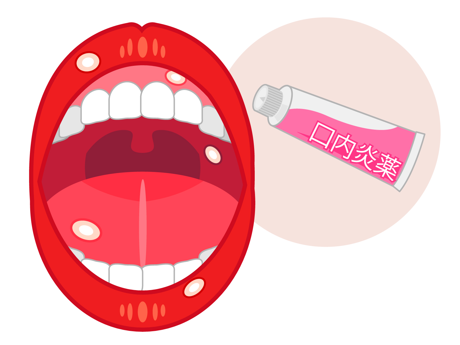 がん治療による口内炎 治療前の歯科診療で予防をトピックス時事メディカル時事通信の医療ニュースサイト