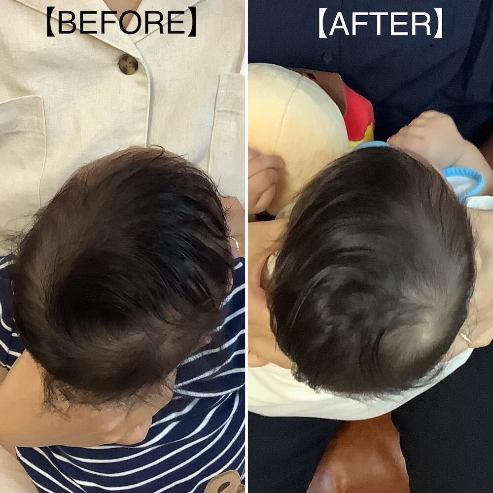 長頭症の整体赤ちゃんの頭の歪みの治し方を大阪の整体サロンINUIが解説整体サロンINUI
