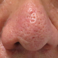 急な片方の鼻づまりは注意~鼻内の腫瘍 - 熊本 くまモンファン 耳鼻咽喉科医の みみ・はな・のど あれこれ