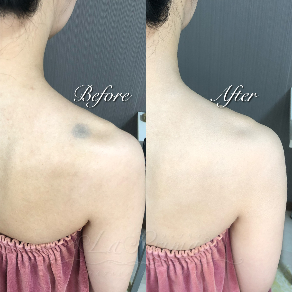 蒙古斑について至急お願い致します！ - 昔から背中の上部分に大きめの蒙古斑があ- Yahoo!知恵袋