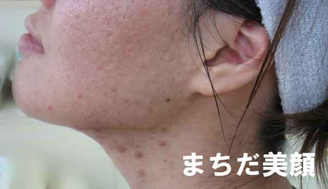 医療従事者監修 首ニキビの原因と対策について部位＆男女別で解説！跡が治らないときは？綺麗に治したい場合はどうする