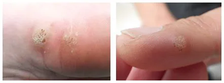 いぼ・水いぼの治療コアラ皮膚科・美容皮膚科クリニック三軒茶屋三軒茶屋・池尻大橋・駒沢大学・若林・世田谷