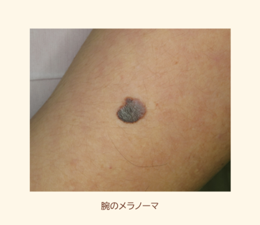 痣 あざ の原因と治療法を解説――できやすい体質や消えないケースも専門医が説明します