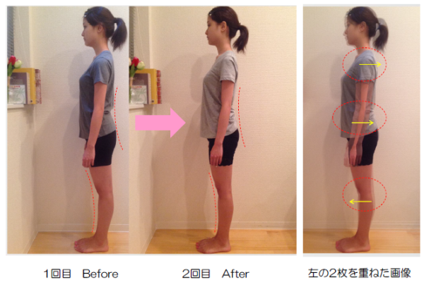 骨格ウェーブ 横から見ると どのような体型に見えるの？ - カイラックス姿勢矯正院