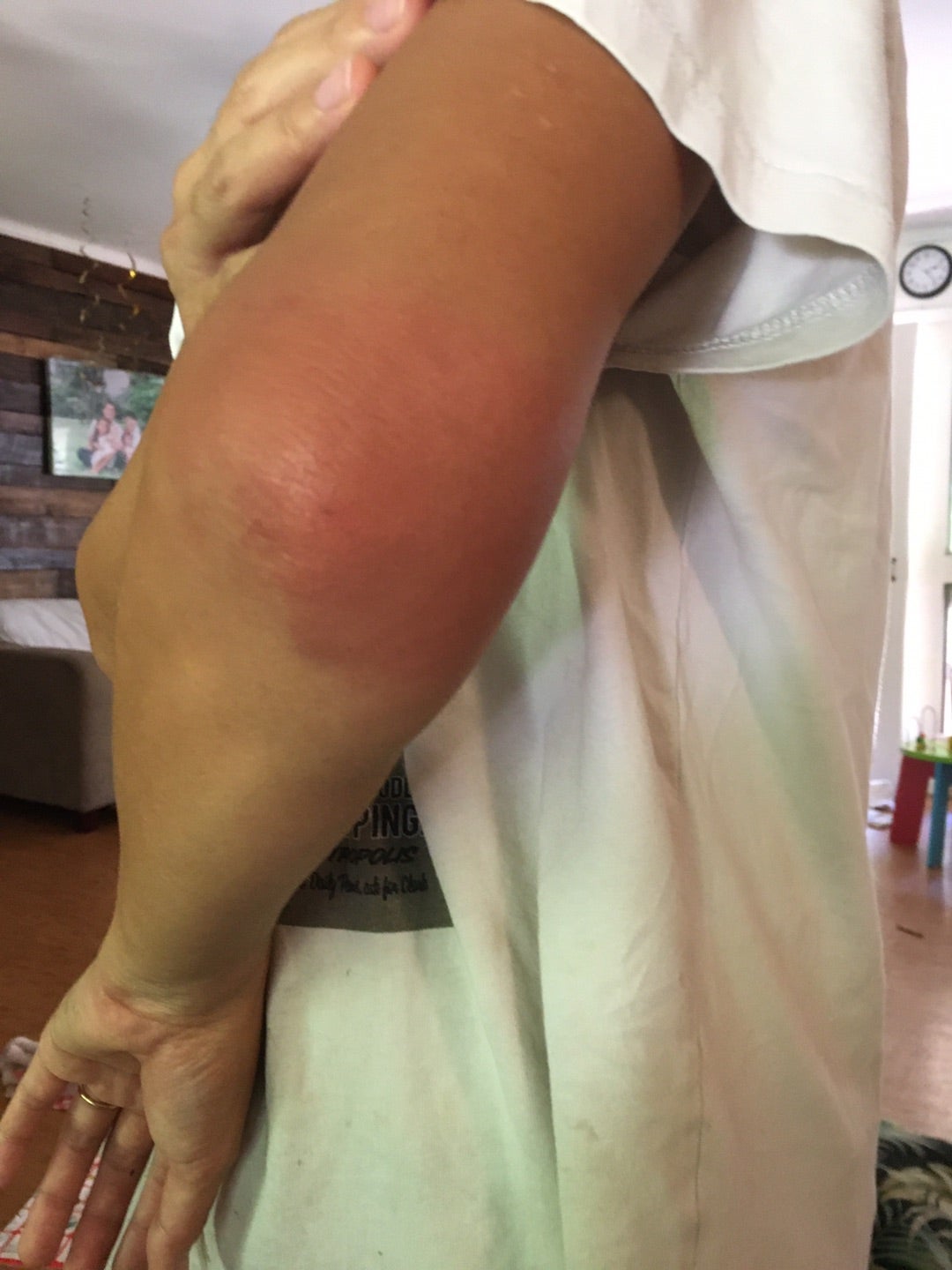 虫刺され Q9 - 皮膚科Q＆A 公益社団法人日本皮膚科学会