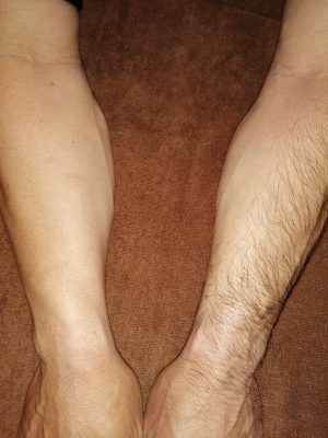 メンズ 男性 の足指の医療脱毛とは？エミナルクリニックメンズ メンズエミナル