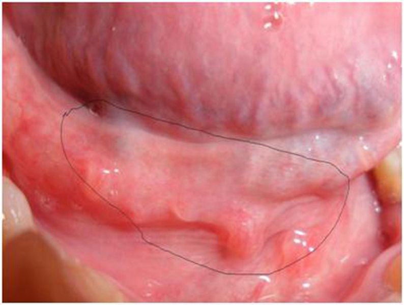 咽頭淋菌による性感染症の症状・検査・治療港区の麻布十番たちばな泌尿器科・皮膚科クリニック