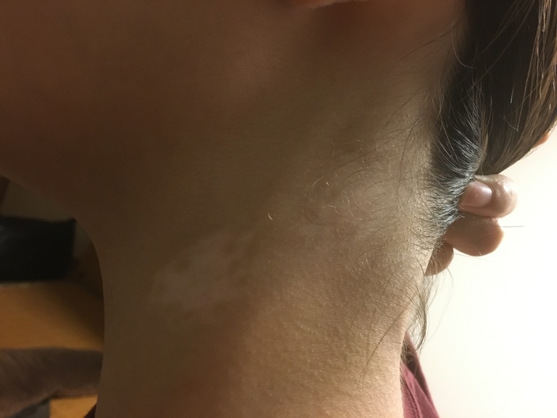 国立市での尋常性白斑治療谷保駅前皮フ科